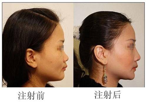 隆鼻后遗症