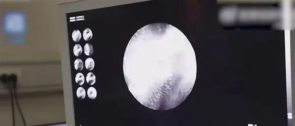 女生喝热水缓解胃痛半年后查出胃癌，喝热水与胃癌有关？