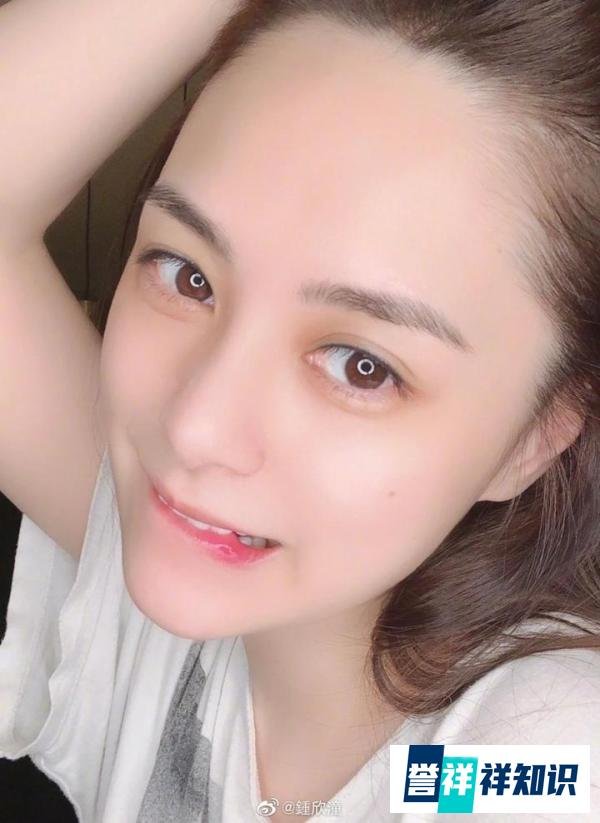 突发！钟欣潼屙夜尿发生意外头部重伤，伤口缝数十针随时破相！