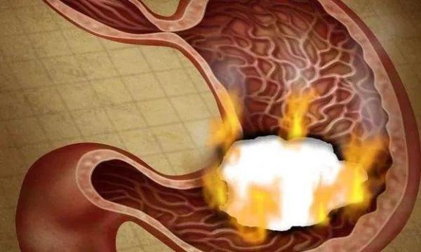 女生喝热水缓解胃痛半年后查出胃癌，喝热水与胃癌有关？