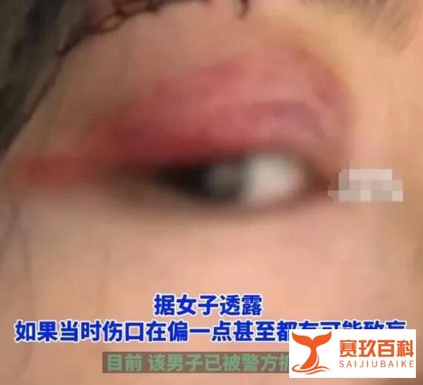 女孩等电梯时被男子恶意顶撞，导致眼睛受伤，差点就失明！