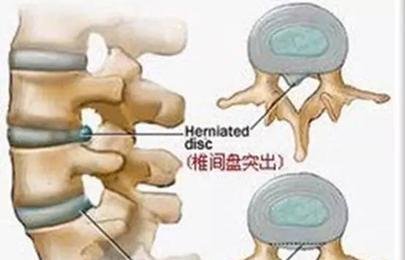 “北京瘫”原来是病！三组颈腰动作可保护