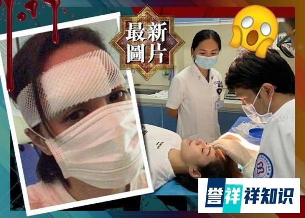 突发！钟欣潼屙夜尿发生意外头部重伤，伤口缝数十针随时破相！