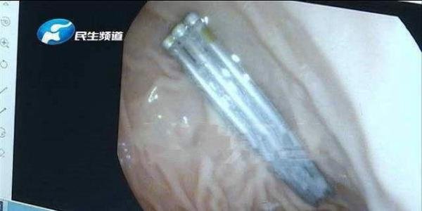 1岁婴儿胃内发现3根6cm长钢钉！这些潜在的危险家长朋友们千万别大意